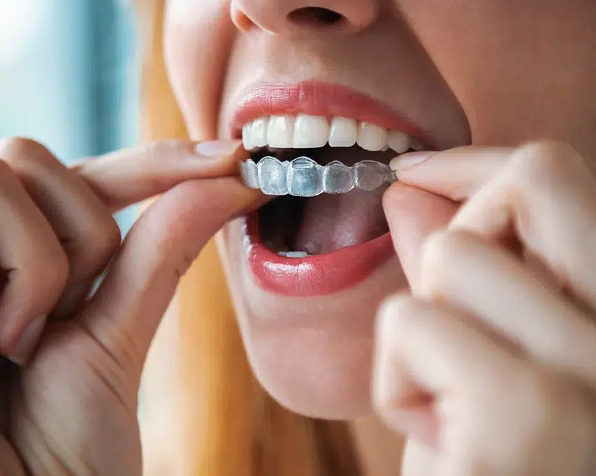 Invisalign in South Austin