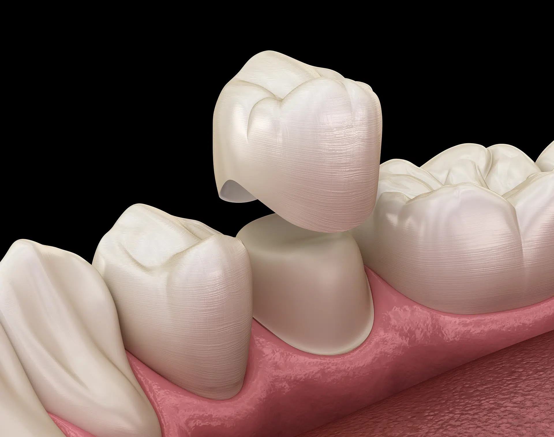 Dental Crowns in South Austin Dental Crowns in Austin