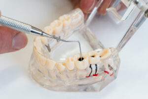 Root Canal Therapy Austin