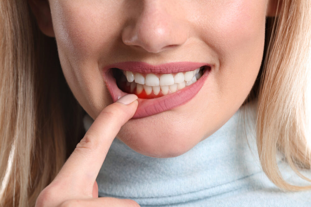 Gum Disease Austin