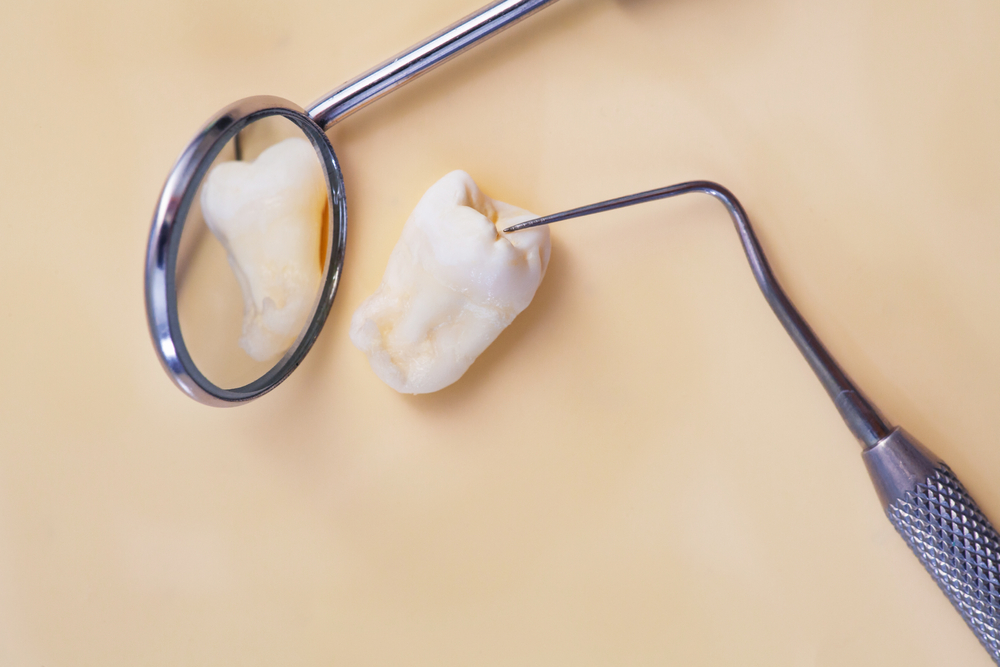 wisdom teeth removal austin